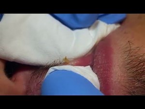 Extracting Comedones