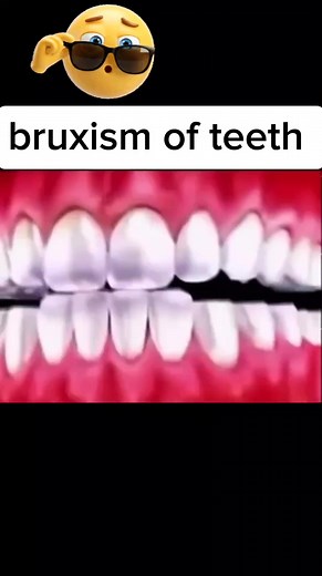 1K views · 215 reactions | Bruxism of teeth and symptoms and causes and treatment in first comment  #bruxism #reels #Video #teeth_bruxism #grinding #dental #dentist #dentistry #tips #trick #Hj #highlight #vira #صرير_الاسنان #طحن_الاسنان #طب_الاسنان #اليمن | DrHazim Jamil | Facebook