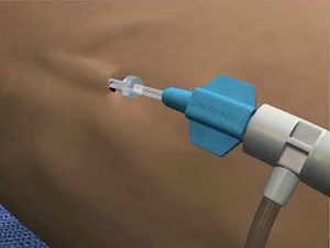 Laser for Veins / Endovenous Laser Ablation - AngioDynamics NeverTouch(R) Venacure EVLTTM