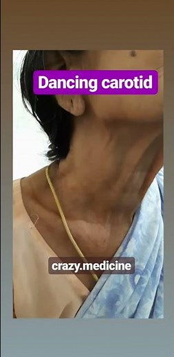 Dancing Carotids | Aortic Regurgitation