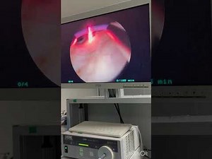 TUIP- Transurethral Incision of Prostate ( Prostatın Insizyonu )- Prof. Dr. Mustafa Levent Emir