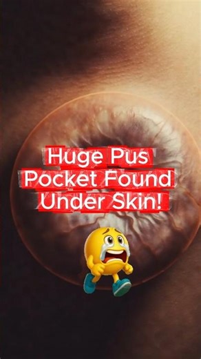 The Hidden Dangers of a GIANT Abscess Growing Inside You