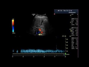 Understanding ultrasound parameters: mechanical index and thermal index