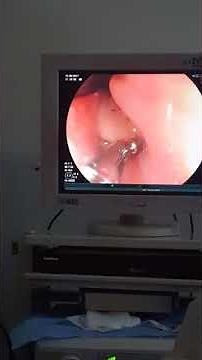 Endoscopia y Biopsia, gastritis o esofagitis? Parte 2