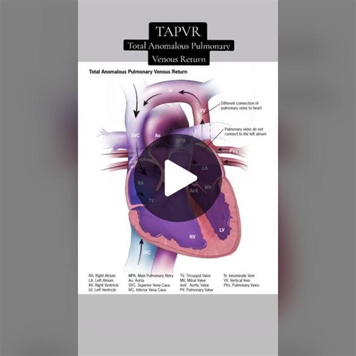Total Anomalous Pulmonary Venous Return (TAPVR) Explained