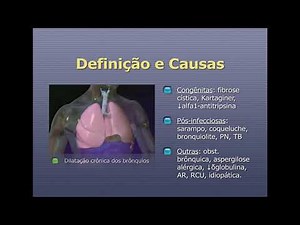 Bronquiectasia