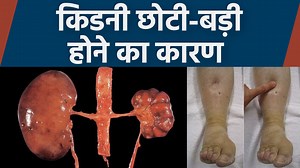 What happens when the kidney becomes small? Causes of kidney enlargement | Boldsky*Health #Kidney #Small Kidney #Causes of kidney enlargement | Boldsky | Facebook