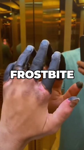 Understanding Dry Gangrene from Frostbite: Amputation Procedure Explained