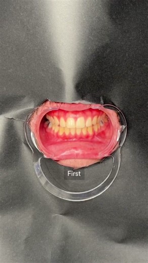 Clareamento Dental Natural: Mitos e Verdades | Testando Clareador Jaysuing