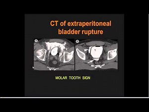 7-IMAGING ABDOMEN TRAUMA URINARY BLADDER TRAUMA PART 7 Dr AHMED ESAWY