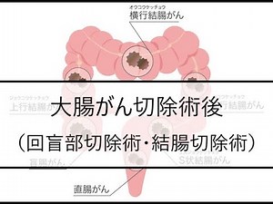 【看護学生向け】 【疾患別 看護診断】大腸がん切除術後（回盲部切除術・結腸切除術）｜アセスメントと計画立案