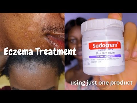 Eczema Treatment - How to Get Rid of Eczema using Sudocrem