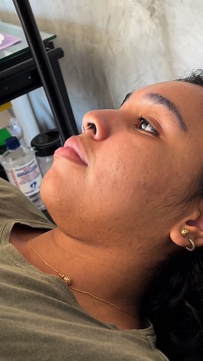 Procedimento Narrado de Vertical Labret