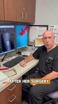 Dr. Buch explains why NanoKnee. Here's an x-ray of two knees that need NanoKnees! #kneepain