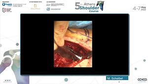 Relive Surgery: Reverse Shoulder Arthroplasty Technique