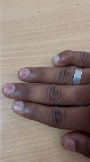 Subungual hemorrhage/Splinter hemorrhage