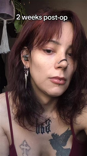 FFS Update: Two Weeks Post-Op Recovery