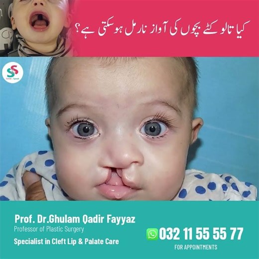 Achieving Clear Speech After Cleft Palate Surgery | Dr. Ghulam Qadir Fayyaz