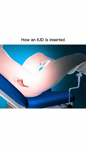 Animations on Instagram: "Another @surgicalanimation "