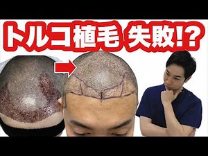 【トルコ植毛!?低密度!スカスカ!?バラバラ!?】海外で植毛を受けて不満足な仕上がりになってしまった患者様の症例