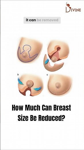 How Much Can Breast Reduction Surgery Reduce Size?