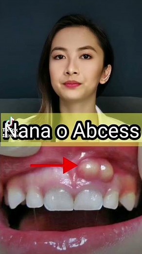 Bukol sa gilagid? Nana o abcess na yan! #youtubeshorts #shorts