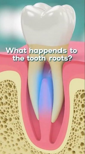 🦷 What Happens to the Tooth Roots During an Extraction?
