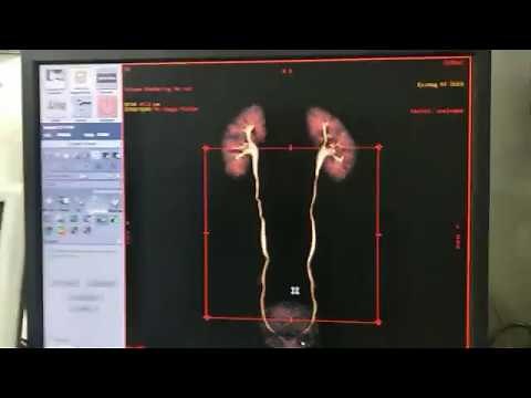 Full Work Of CT Urography (Urogram with 3D) On GE 16 Slice Scanner.