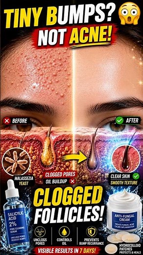 Why Tiny Forehead Bumps Keep Coming Back 😳 #SkinCare #Dermatology