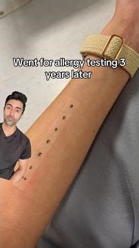When Swelling Isn’t an Allergy
