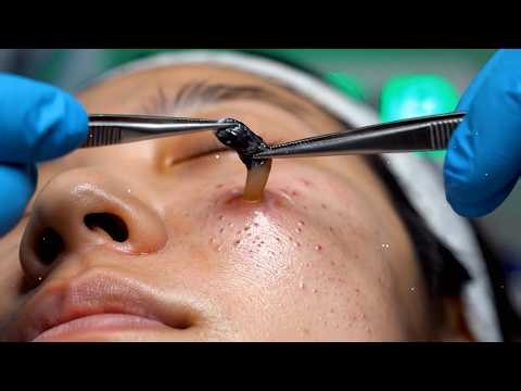 Dr. Lee Blackhead Removal without Extractor Tool! Soothing Skincare Treatment, float inward #287
