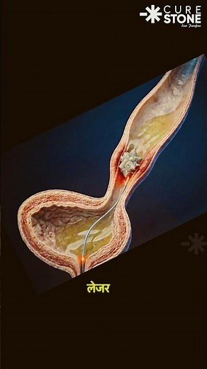 VUJ Stone Treatment | How VUJ(vesicoureteric ) stone is treated #urology