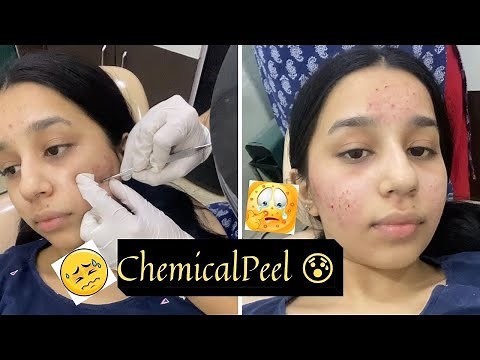 My First Chemical Peel Treatment For Acne! | My Experience Of 7 Days with Pictures!!