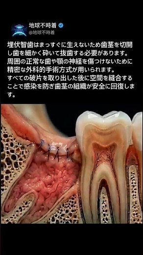 3Dで見る親知らずの抜歯プロセス歯を砕いて抜くべき科学的理由