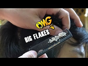 Scratching Dandruff With Comb!! Itchy Dry Scalp (Dandruff Removal)
