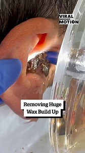 Huge Ear Wax Build Up 👂🤢 | Viral Motion