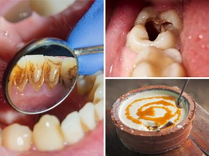 Home Remedies For Tooth Cavities : பல் சொத்தை அடுத்த பல்லுக்கும் பரவாமல் தடுக்கும் அதிமதுரம்... வேறு என்னென்ன வீட்டு வைத்தியமெல்லாம் இருக்கு...