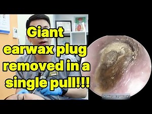 Giant earwax plug removed in a single pull | ear cleaning | ASMR earwax | soothing |relax|