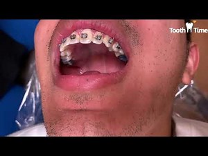 Loose Molar Band - Braces Emergency - Tooth Time Family Dentistry New Braunfels Texas