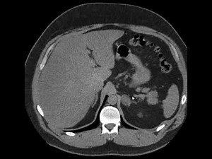 Adenoma adrenal