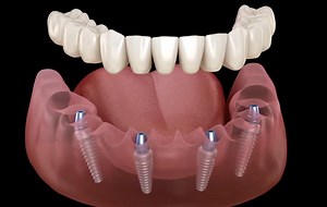 Dentures That Look & Feel Natural