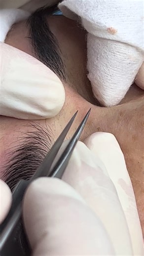 Lấy mụn gạo,mụn chân sâu dưới bề mặt da #lấymụnbằngnhíp #mụn #peonyspa #spapeony #ilovetiktok❤️