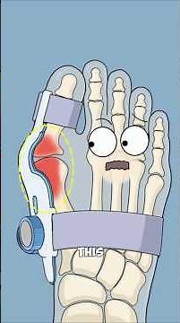 How Doctors Fix A Bunion