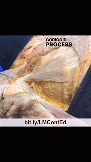 LearnMuscles Cont. Education on Instagram: "🔹 LearnMuscles.com 🔹 Excellence-in-education ✨ Here is a short video clip of a cadaver video of the pectoralis ATTACHMENTS: The pectoralis minor attaches from the coracoid process of the scapula to ribs #3-5. ACTIONS: Protracts the scapula at the scapulocostal joint. Depresses the scapula at the scapulocostal joint. Downwardly rotates the scapula at the scapulocostal joint. Elevates ribs #3-5 at the sternocostal and costospinal joints. 
