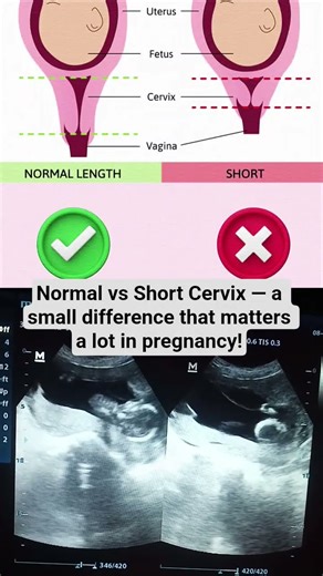 Normal vs Short Cervix Length in Pregnancy | Kawal Awan Ultrasound World #ultrasound #shorts