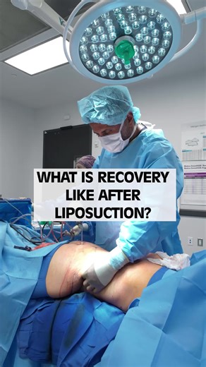 Swollen today, sculpted tomorrow ✨ Dr. Rozbeh Torabi talks through what liposuction recovery really looks like—and why patience is key. #Liposuction #RecoveryJourney #BodySculpting #DrRozbehTorabi