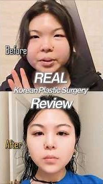 Emma's Experience at Ruby Plastic Surgery | Seoul, Korea