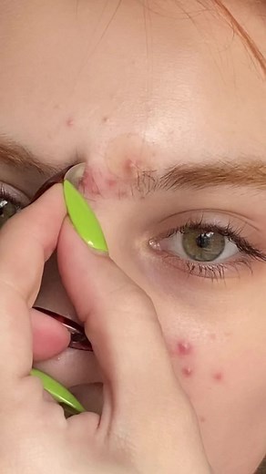 Mighty Patch Peel for Pimple Patches | Hero Cosmetics