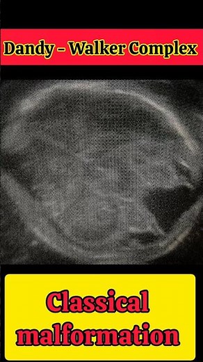 Dandy - Walker Complex.