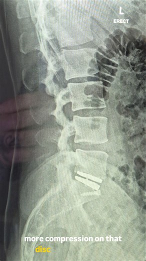 L5/S1 Disc Replacement Surgery (Day 4) #lowerbackpain #discbulge #sciatica #sciaticarelief